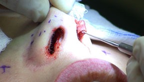 Exposing lower lateral cartilage during rhinoplasty