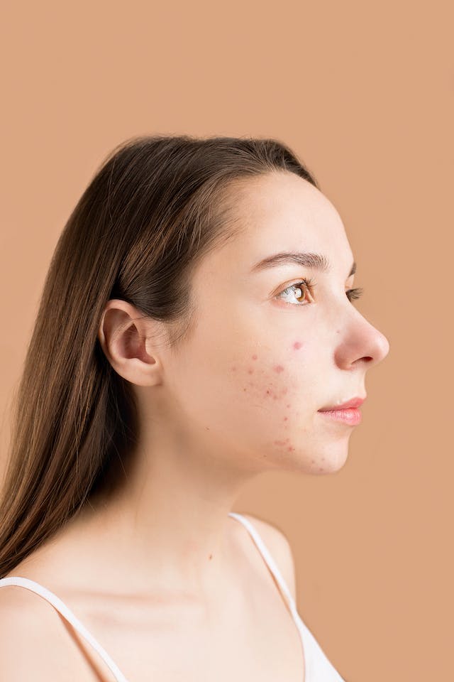 How to Moisturize Acne-Prone Skin Correctly