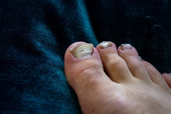 Types of skin and nail diseases which can be really annoying