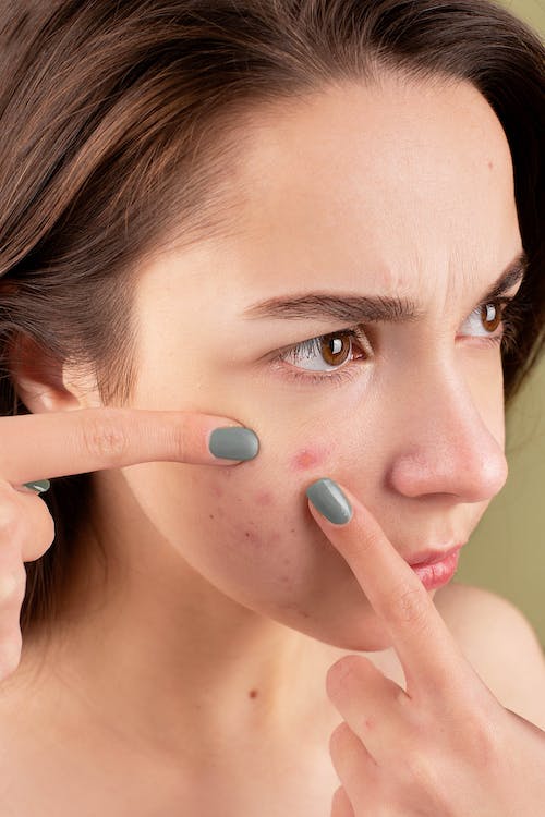 5 Reasons to Treat Your Acne As Soon As Possible