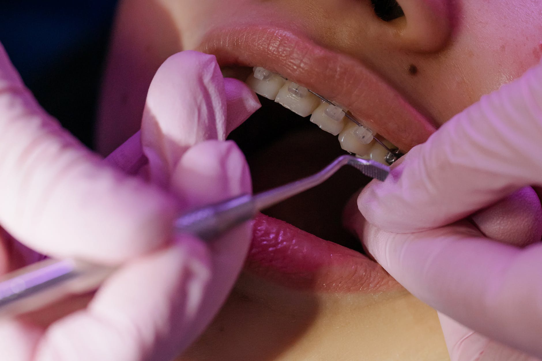 How Can an Orthodontist Help You Choose the Right Braces