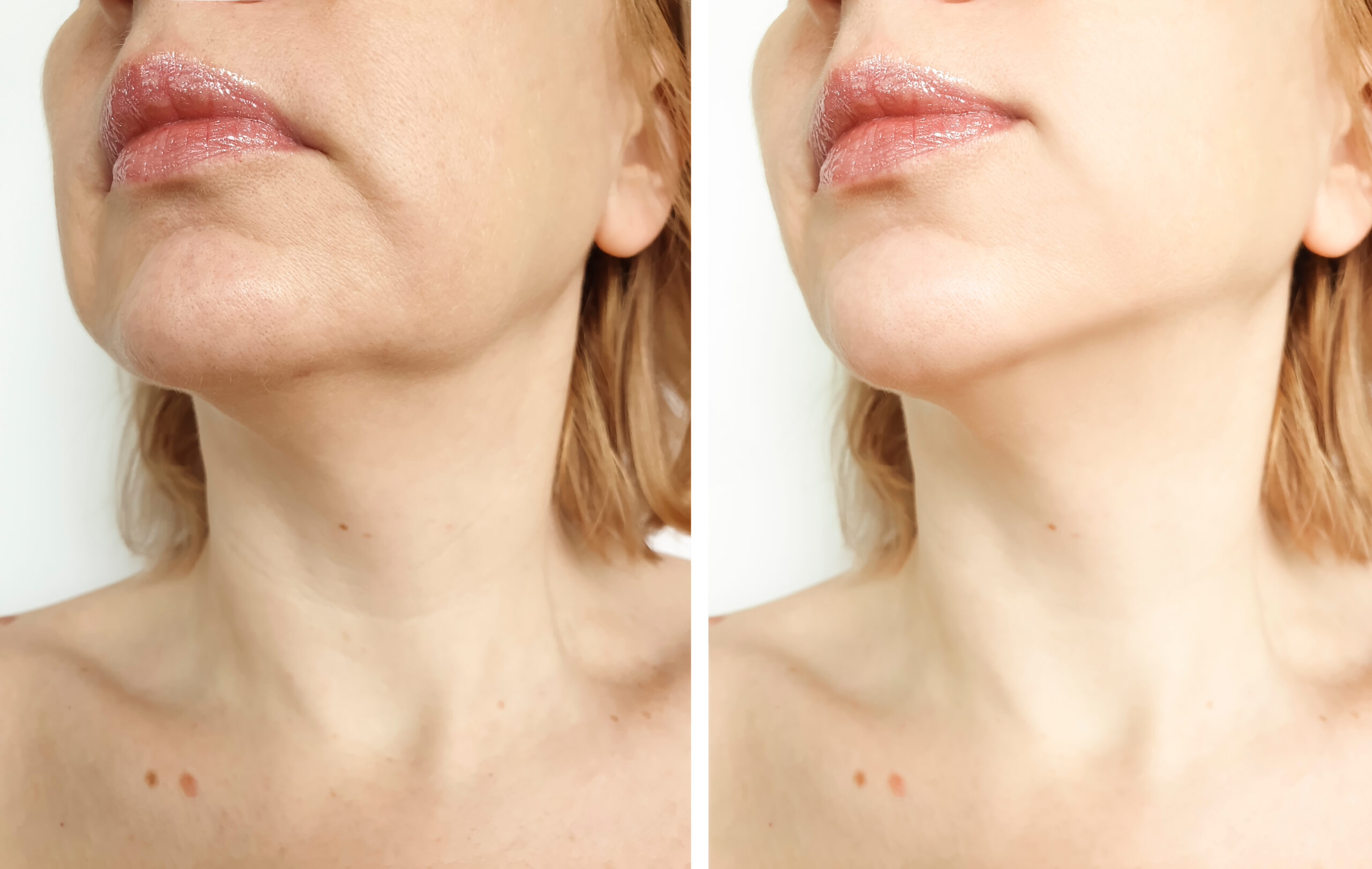Woman,Tightening,The,Chin,Before,And,After,The,Procedure