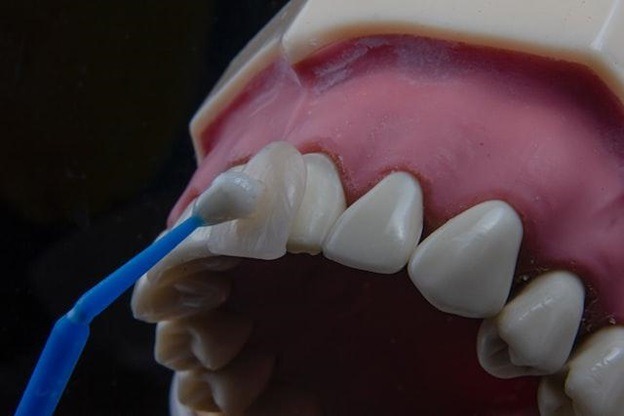 Veneers Make A Beautiful Smile Leaving A Lasting First Impression
